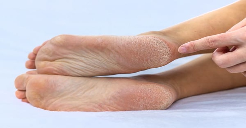 5 Unique Cures for Winter Cracked Heels – Amazing Results!